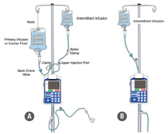 Figure 1. Two methods of administering small-volume intermittent IV infusions:  A (left, recommended): Using a secondary administration set attached at the Y-site (upper injection port) of a carrier fluid or primary infusion administration set (minimizes drug loss).  B (right, NOT recommended): Using a primary administration set connected directly to the patient’s vascular access device (leads to significant drug loss).